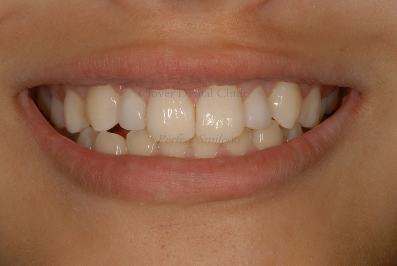 前歯 の 横 の 歯 が 小さい