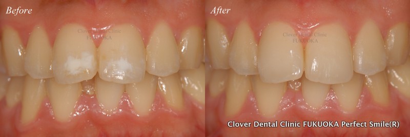 シミ 前歯 茶色い 歯が茶色くなる7つの原因！歯医者さんでできる処置やセルフケアも紹介